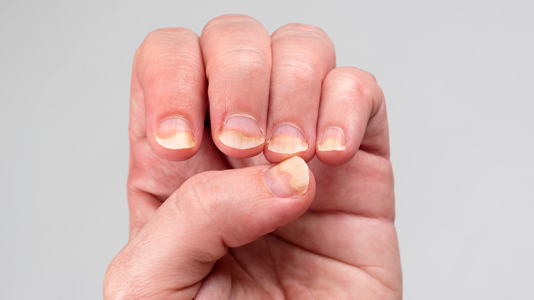 discolored nails on fingers