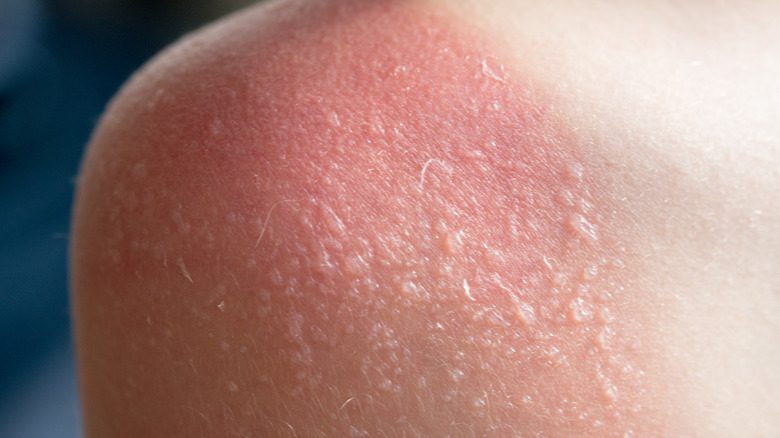 person with sunburn blisters