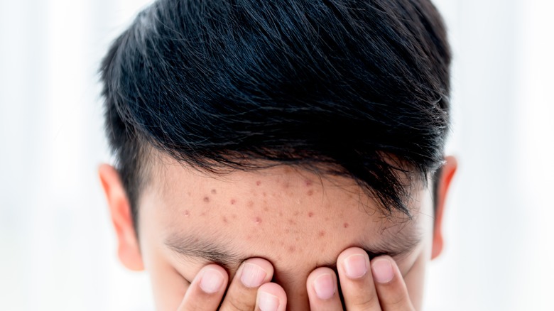 Boy with acne