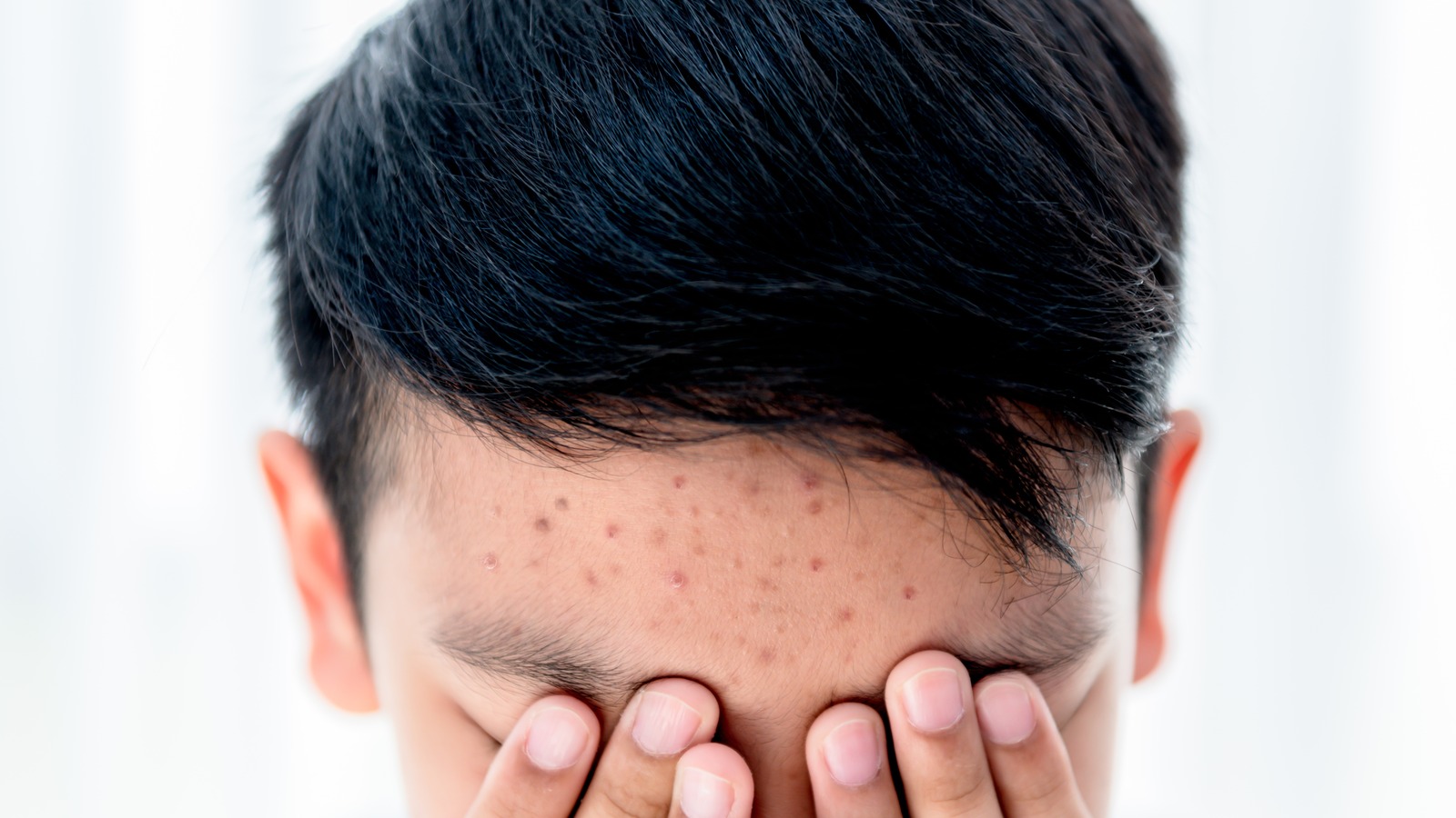 If You Have Acne Along Your Hairline Heres What You Should Do