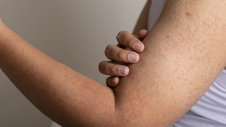 keratosis pilaris on upper arm