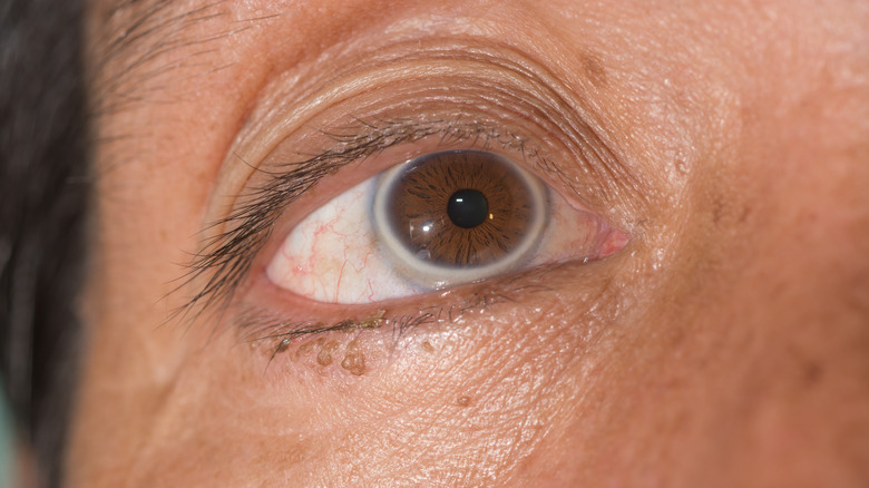 arcus senilis in eye