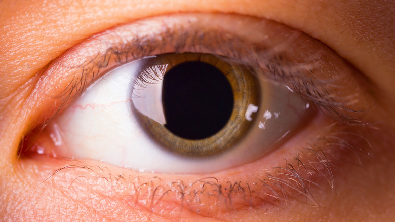 Close-up of a dilated eye
