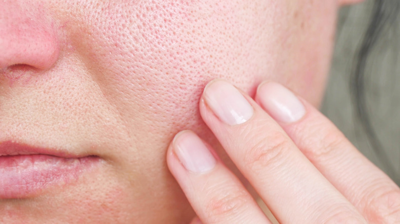 Redness on cheek