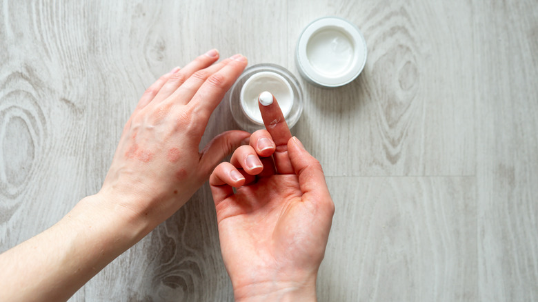 applying eczema lotion on skin