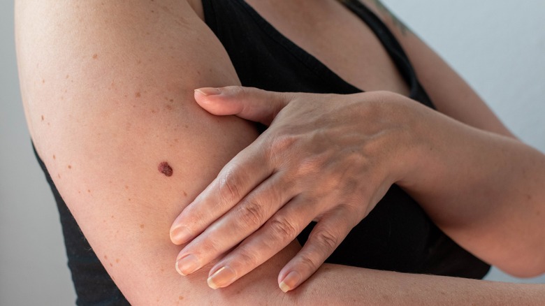 Woman with large mole on arm