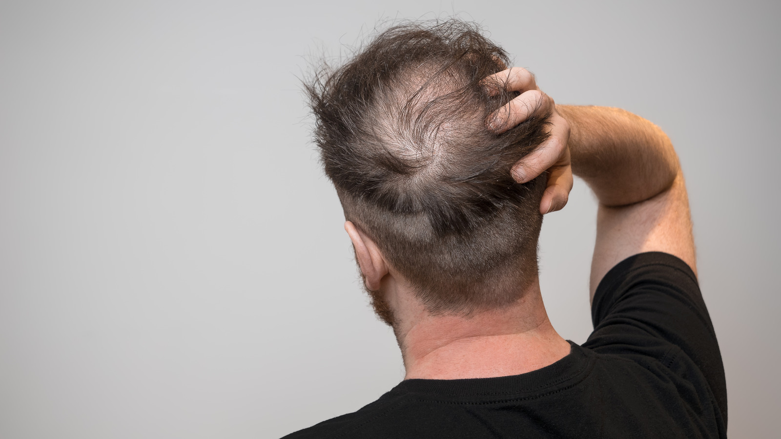 Is Hair Loss Preventable?