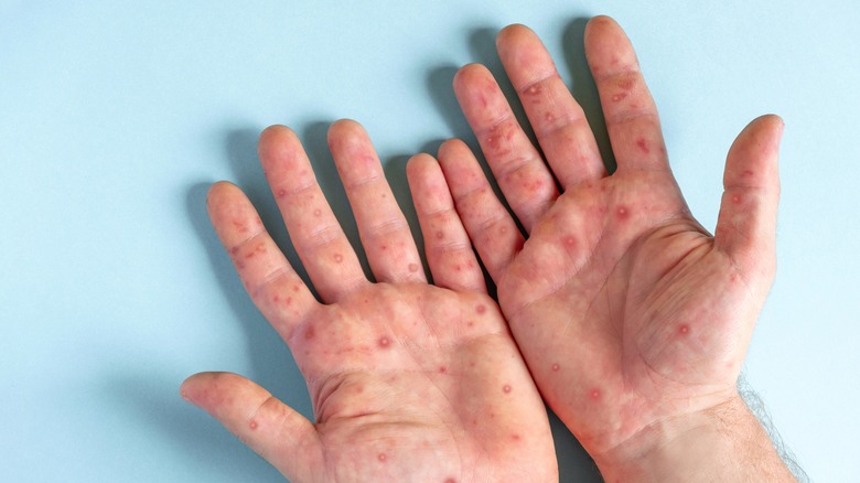 male hands with rash