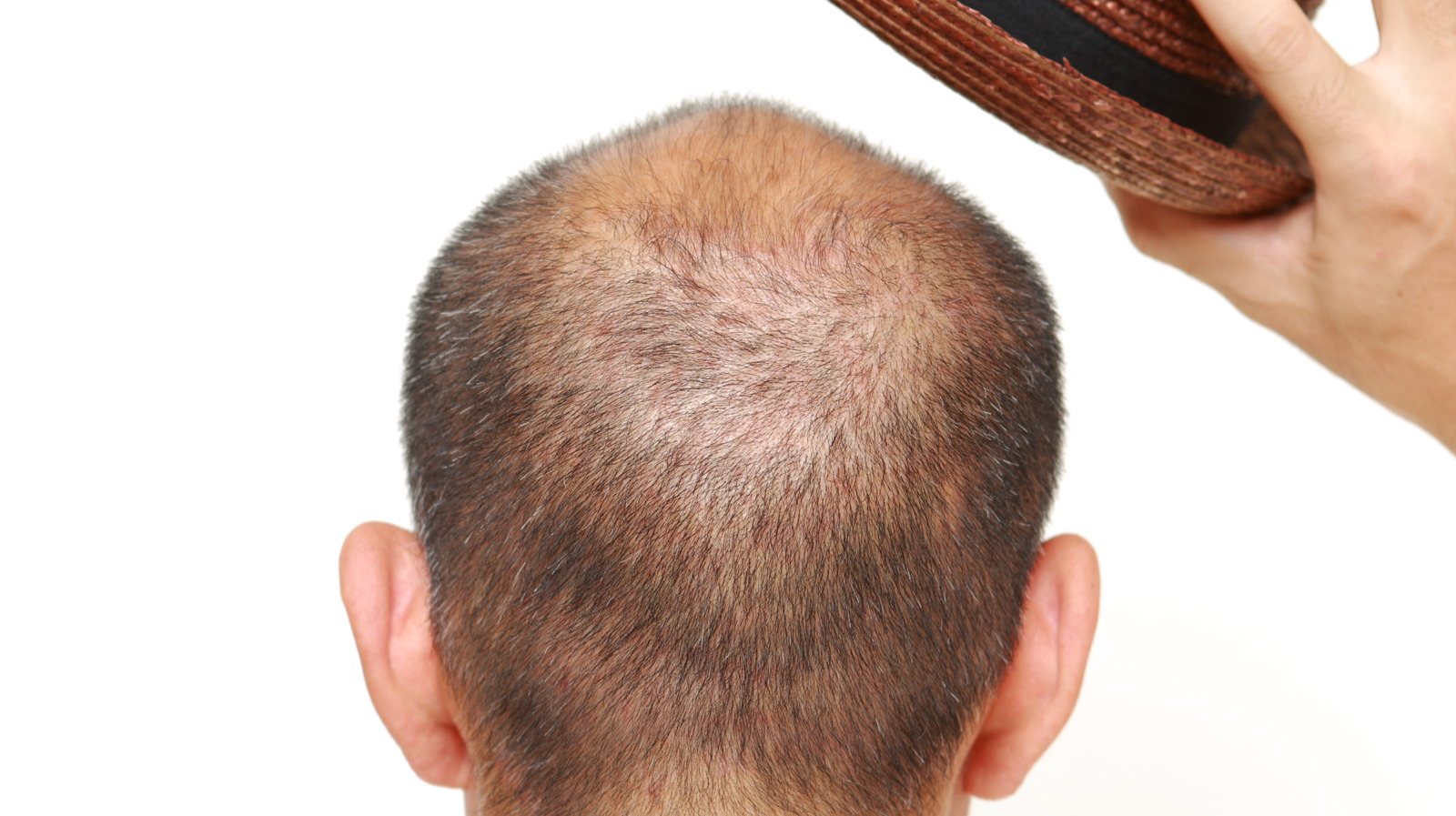 Is It Possible For Hats To Cause Hair Loss?