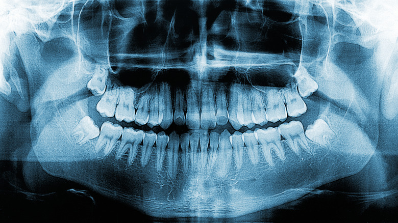 A dental x-ray