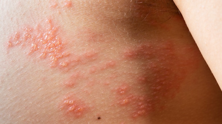 Shingles rash on skin