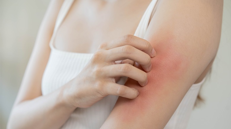 Person with eczema rash on arm