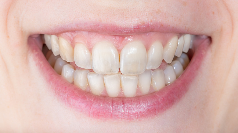 person smiling showing damaged tooth enamel