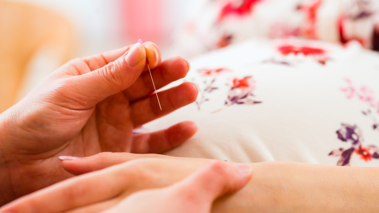 pregnant woman undergoing acupuncture treatment