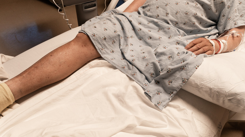 Amputee in hospital bed