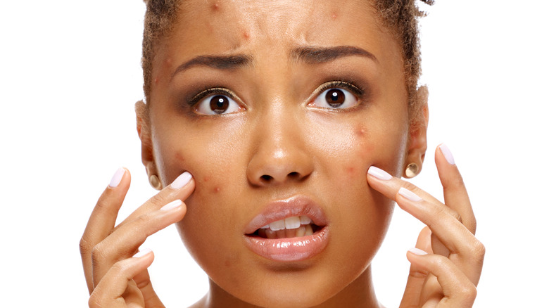 Your Black woman upset about acne