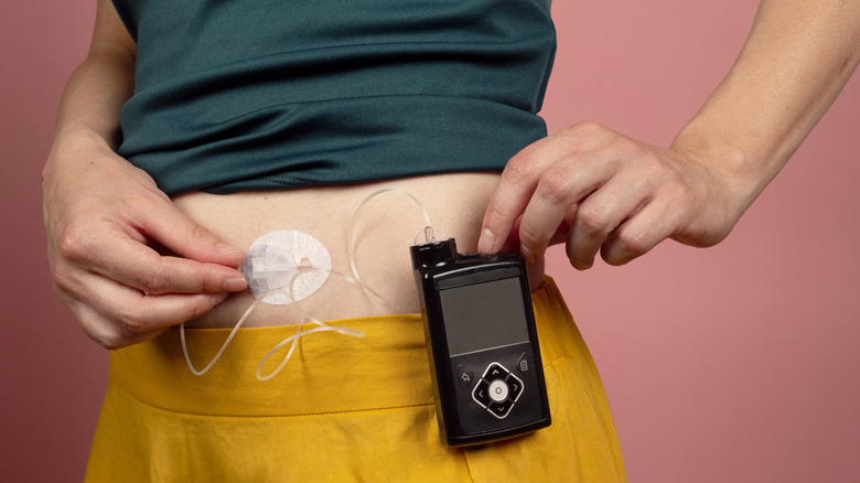 A diabetic with insulin pump