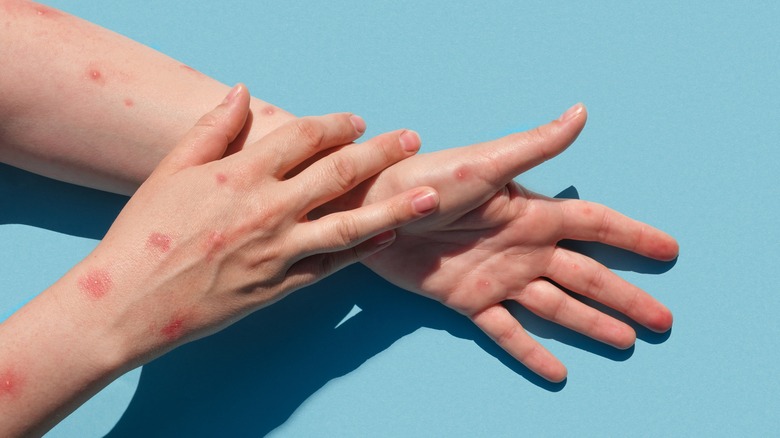Who Is Most Vulnerable To The Monkeypox Virus?