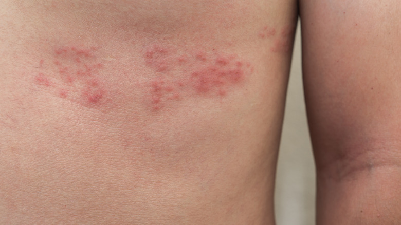 person with shingles rash