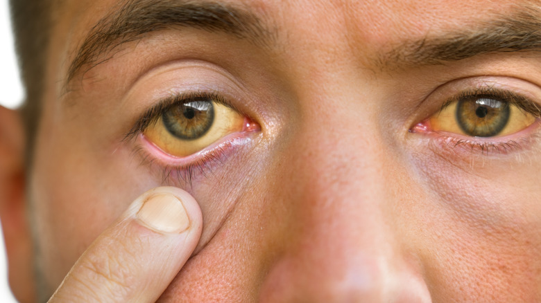 man with jaundice in eyes