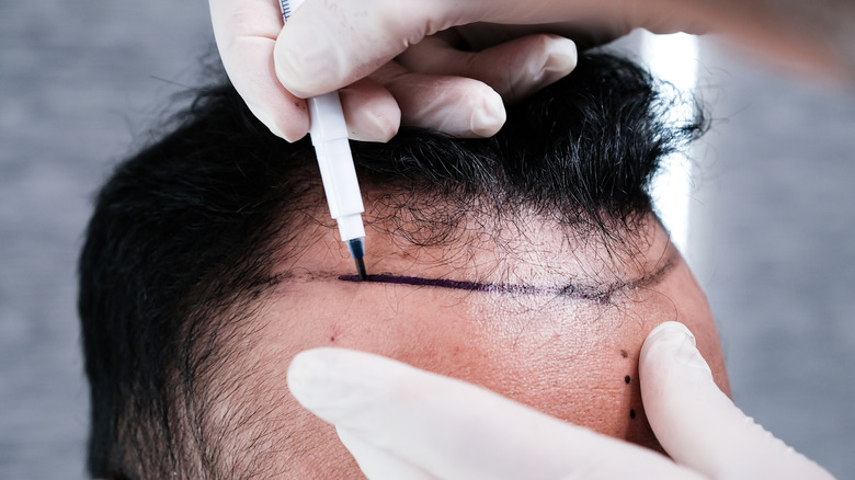 male patient being prepped for hair transplant surgery