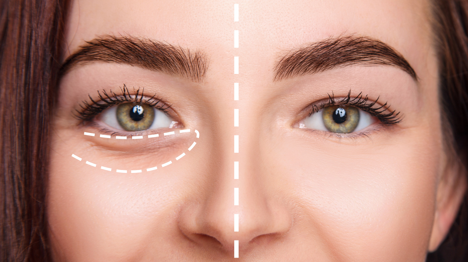 Juvéderm Volbella XC All The Details About The New FDA Approved Under