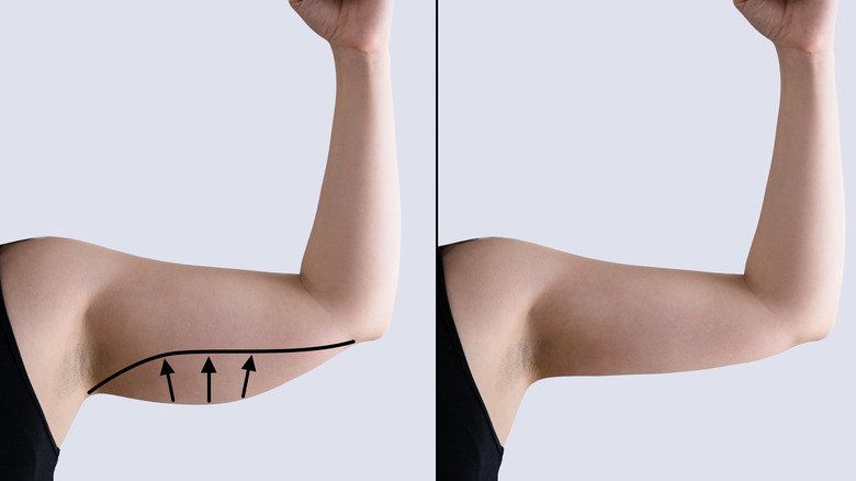 woman's biceps before and after fat reduction