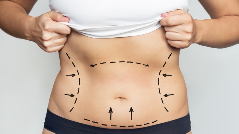 woman with liposuction surgery marks on abdomen