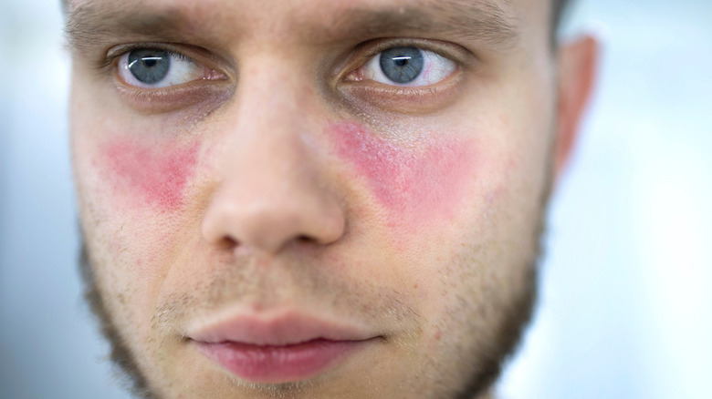 man with lupus facial marks