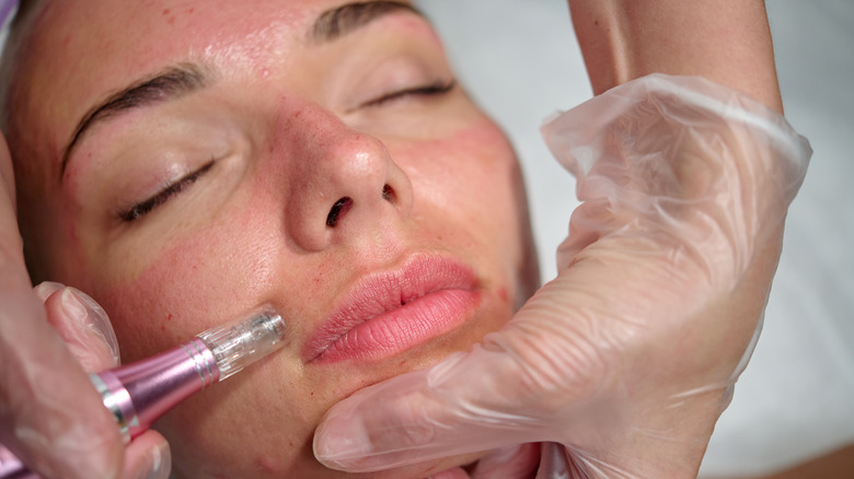 microneedling procedure