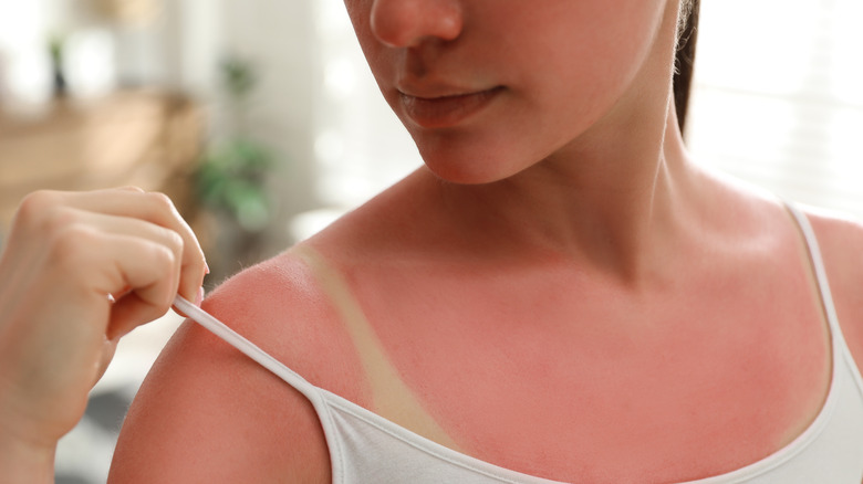 woman with sunburned chest and shoulders