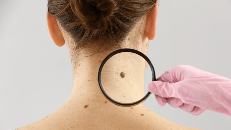 dermatologist examining patient's mole on neck