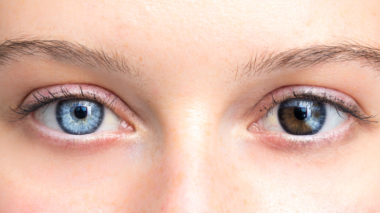 Person with eyes of two different colors