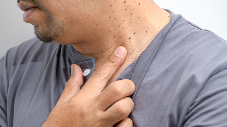 Closeup of skin tags on man's neck