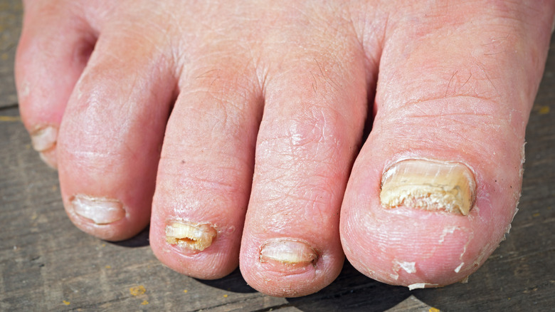 toenail fungus on man's foot