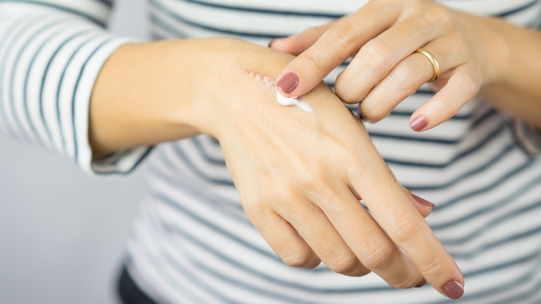 Finger applying cream to scar