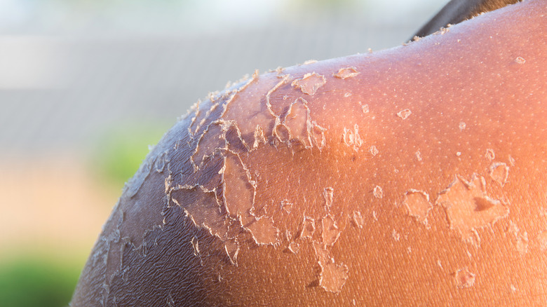 Skin peeling off a shoulder 