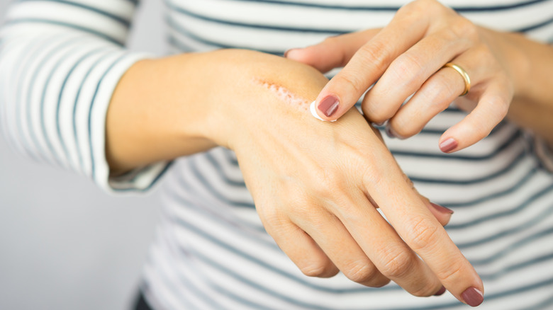Close up of woman applying cream to a burn on her hand