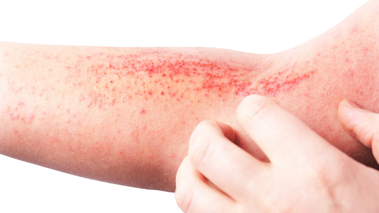 Atopic dermatitis on elbow