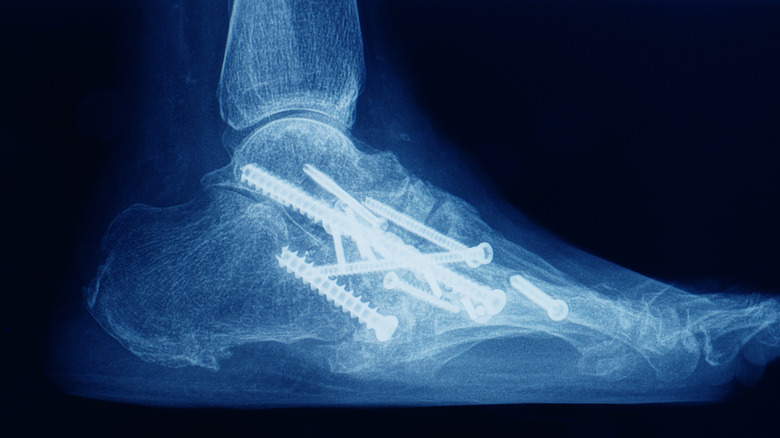 x-ray of ankle infusion
