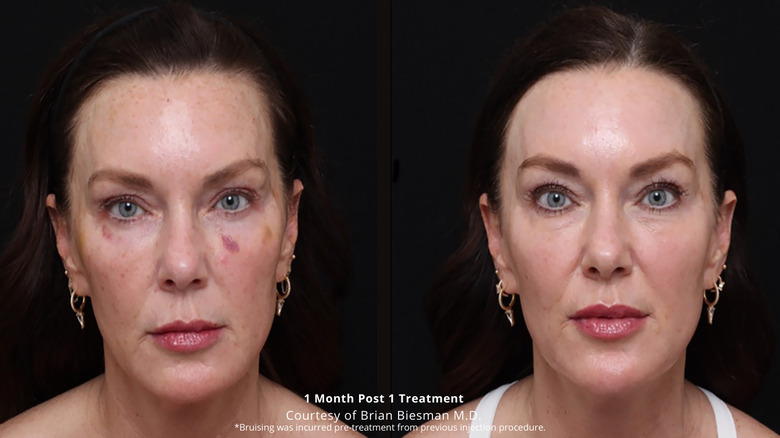 A woman having skincare treatment done