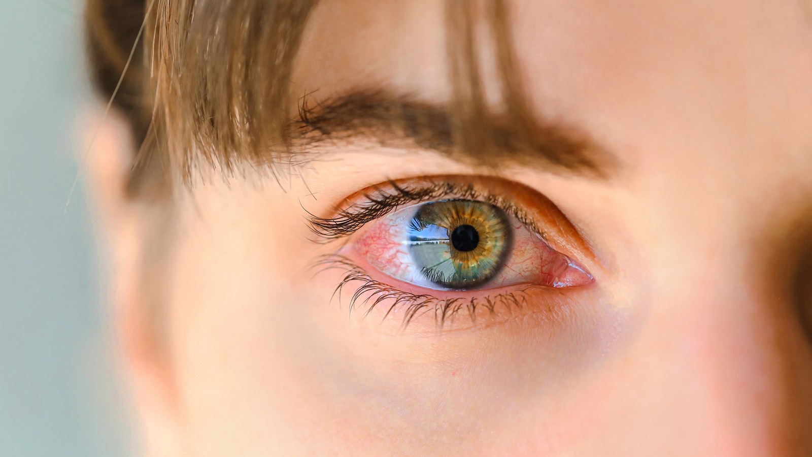 Pink Eye Vs Stye What's The Difference?