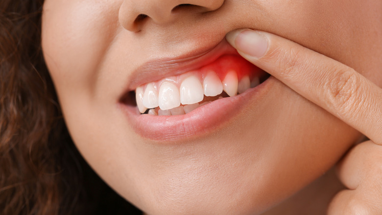 woman showing teeth with inflamed gums