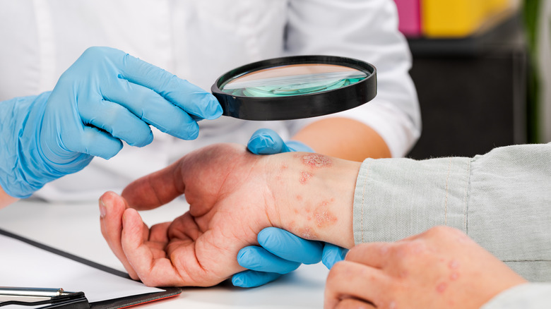 psoriasis examination on wrists and hands