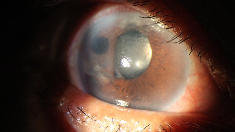 Iris with free-floating cyst