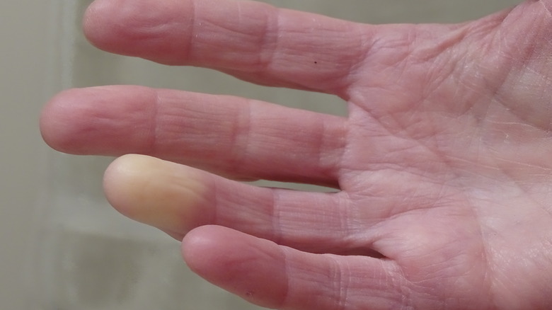hand with Raynaud's syndrome on finger