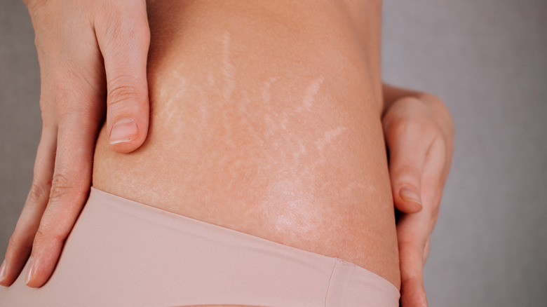 Two hands holding a waist, framing stretch marks on the hips.