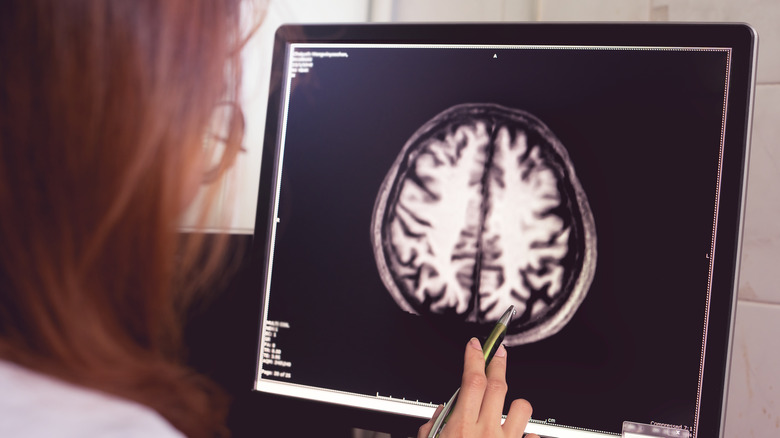 mri of brain scan with Alzheimer's