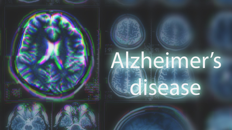 brain scan of Alzheimer's