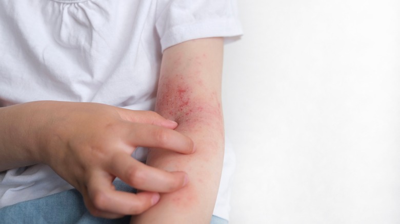 Close up picture of eczema on arm